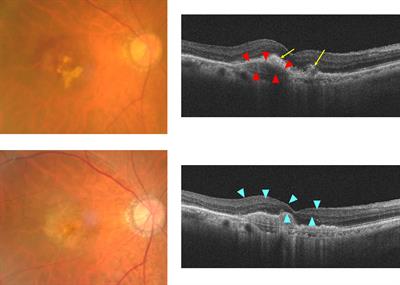 Molecular mechanisms of TGFβ-mediated EMT of retinal pigment epithelium in subretinal fibrosis of age-related macular degeneration